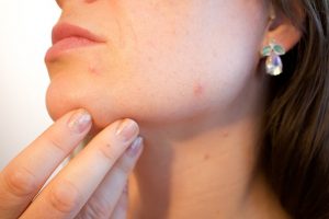 hormonal treatment for acne
