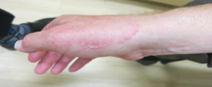 Fungal Infection – Tinea Manuum