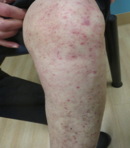 Fungal Infection – Tinea Pedis