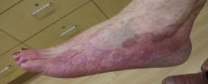 Fungal Infection – Tinea Pedis