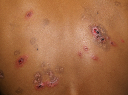 40-Year-Old Male with Recurrent Erythematous Rash - The Doctor's