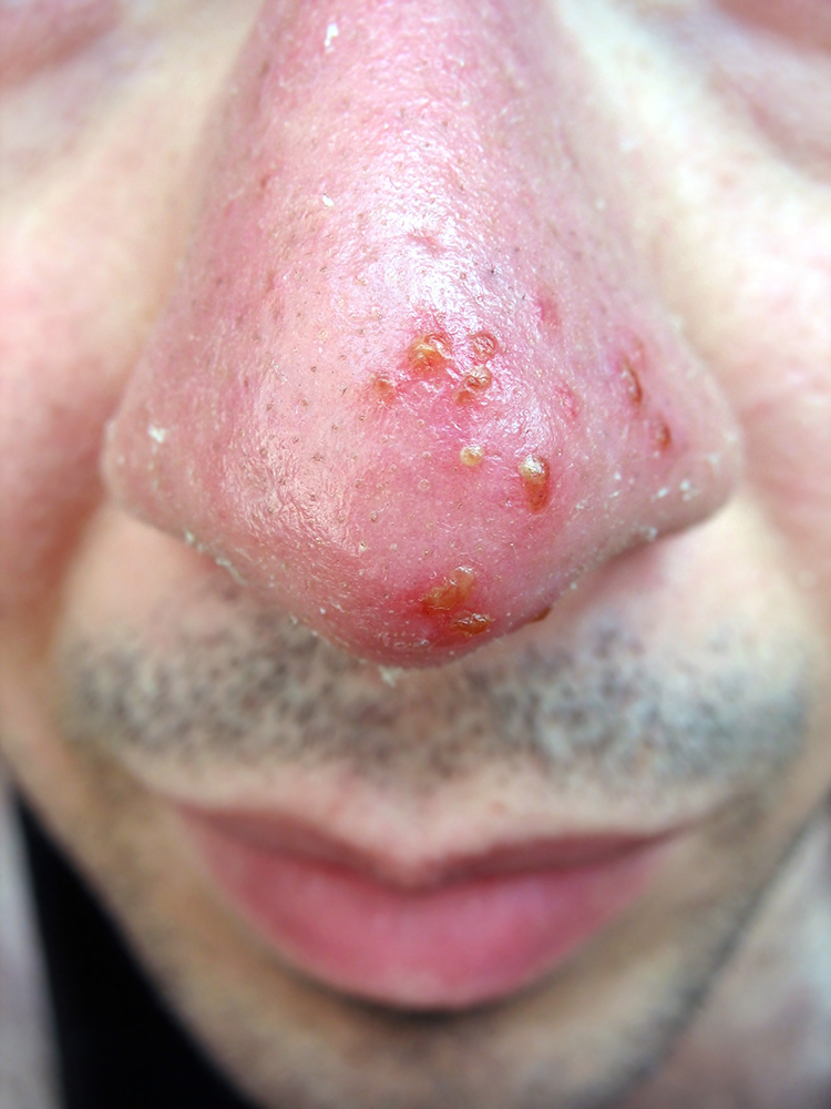 cold sores or acne