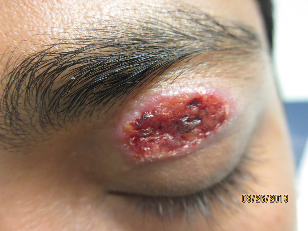 NS Cutaneous Leishmaniasis