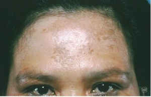 Pop Quiz Melasma