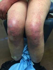 Violaceous Erythema