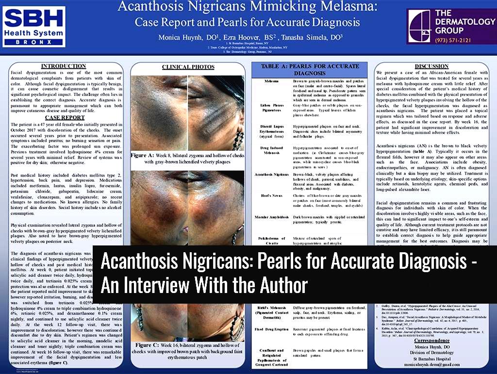 Acanthosis nigricans treatment