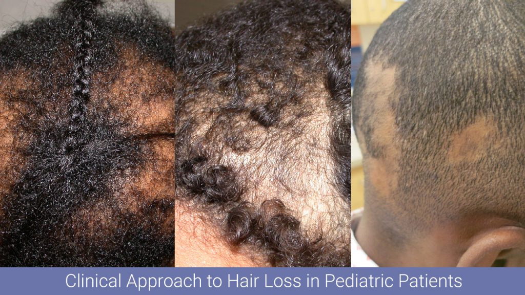 Hair Apparent A MultiPart Series on Hair Disorders Part I A