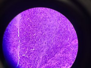 Nodule Biopsy