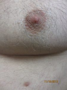 Papule Removal