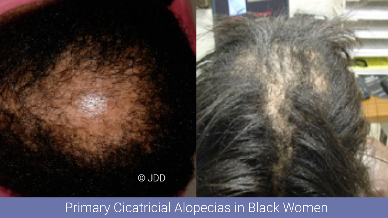 Primary Cicatricial Alopecias In Black Women Next Steps In Dermatology