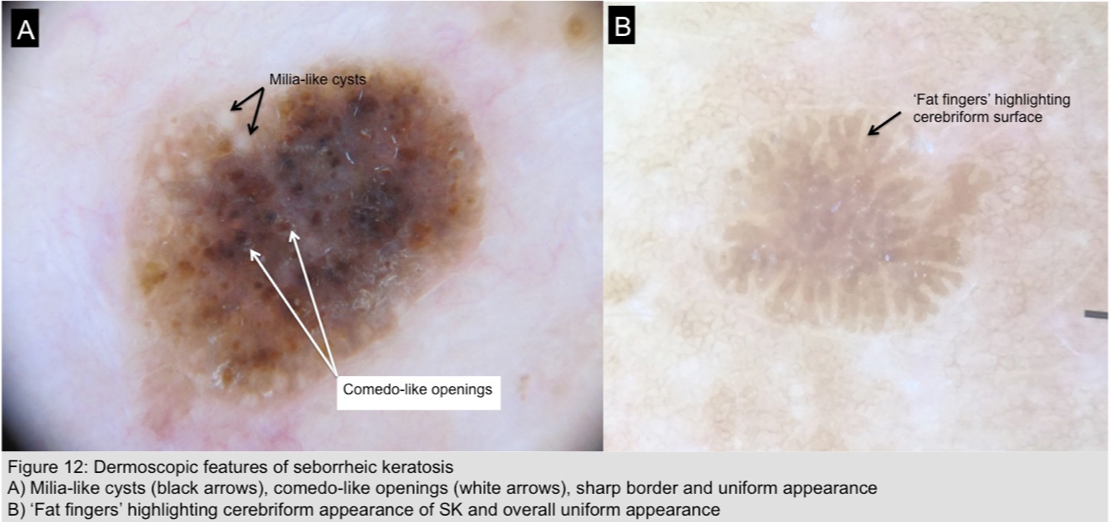 seborrheic keratosis dermoscopy