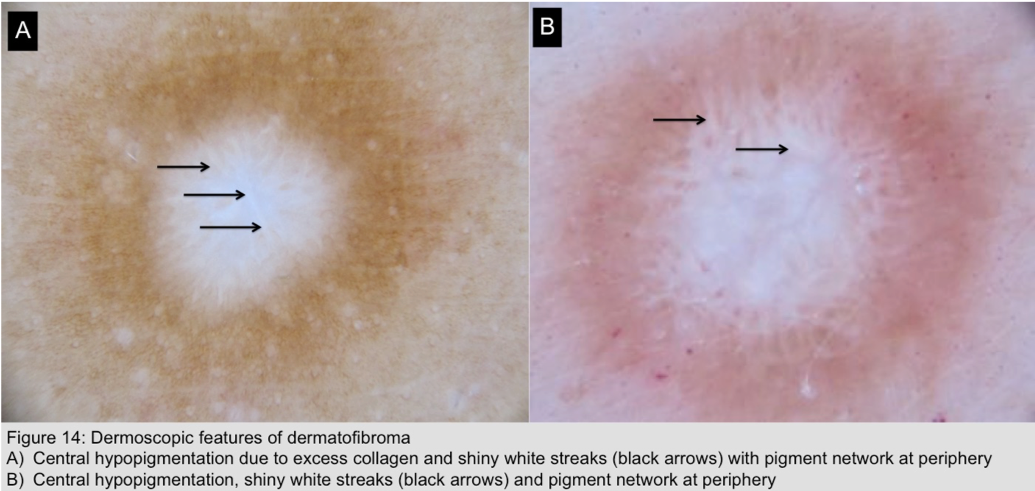 Dermoscopic feature of dermatofibroma of the patient. Central