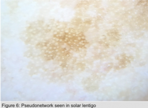 Pseudonetwork seen in solar lentigo