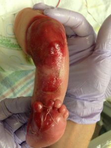 congenital absence of skin