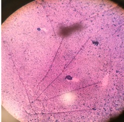 Management of Onychomycosis and Co-Existing Tinea Pedis - JDDonline -  Journal of Drugs in Dermatology