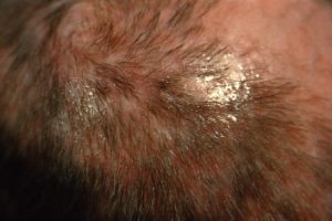 غيداء طلال بصفر🇸🇦 on X: ♦️Clinical findings:it's Causes dermatophytosis  1-Tinea capitis:infection in scalp👨🏼‍🦲and hair💇🏻‍♀️ 2-Tinea barbae:infection  in beard area🧔🏻 3-Tinea corporis:infection in the trunk🤽🏻‍♂️ 4-Tinea  cruris(jock itch