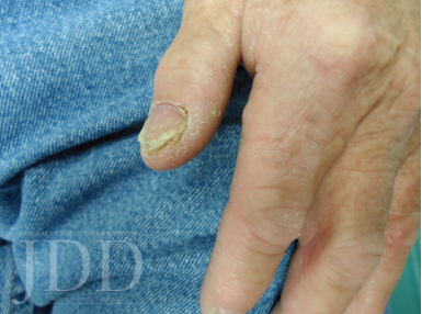 File:Tinea pedis interdigitalis.jpg - Wikipedia