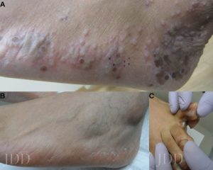 Tinea Pedis / Manuum - Dermatology - Medbullets Step 1