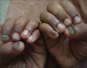 Management of Onychomycosis and Co-Existing Tinea Pedis - JDDonline -  Journal of Drugs in Dermatology