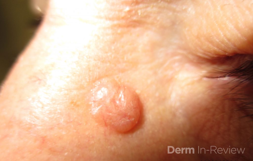 Is It Skin Cancer Tumor Identification Friday Pop Quiz 2 15 Next 