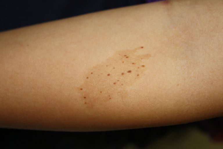 port wine stain Next Steps in Dermatology