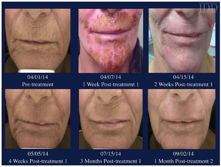 Resurfacing pre and post treatment