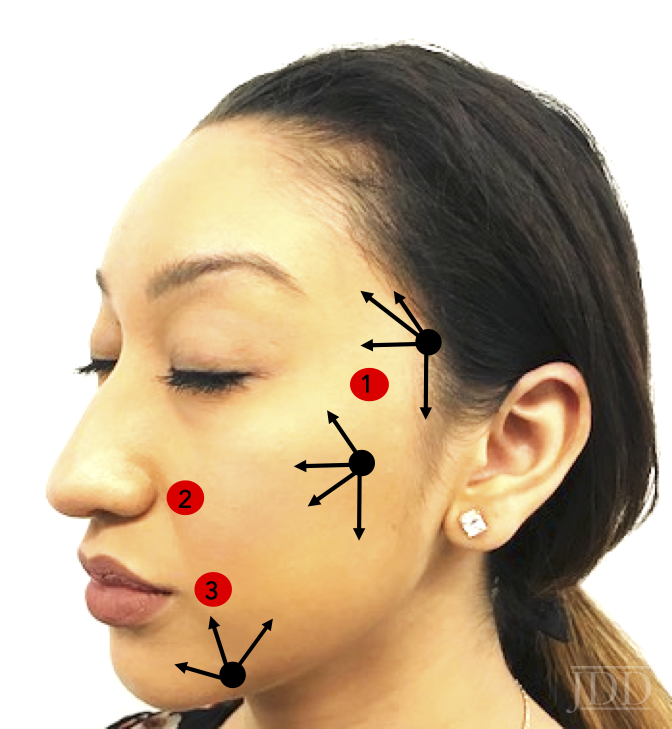 Bimodal trisector approach for volumetric structural rejuvenation (VSRl™).