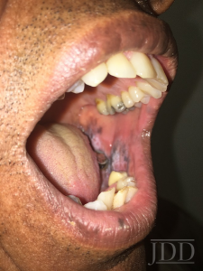 Buccal Mucosa