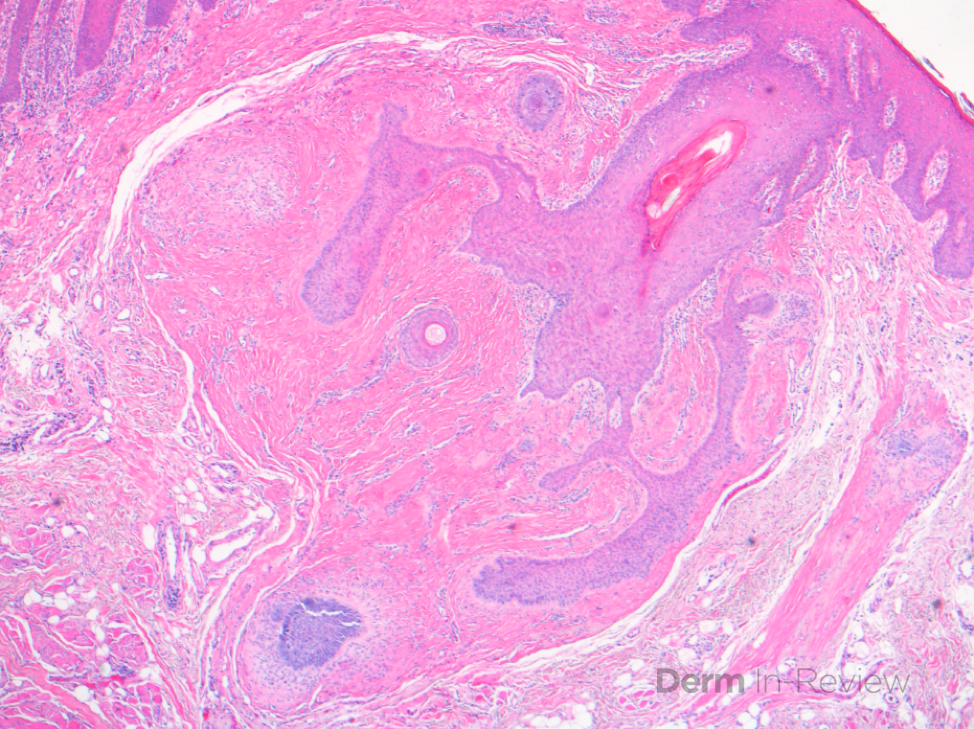 papules pathology