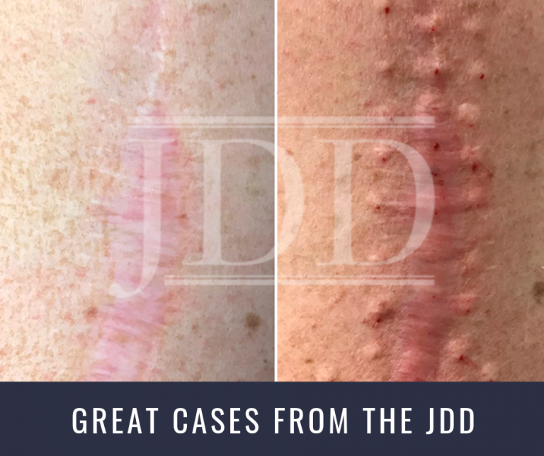 Battling Neuropathic Scar Pain With Botulinum Toxin Next Steps In Dermatology