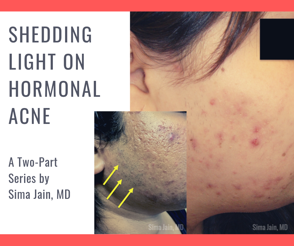 Part 1 Hormonal Acne Exam Work Up Diagnosis Next Steps In 