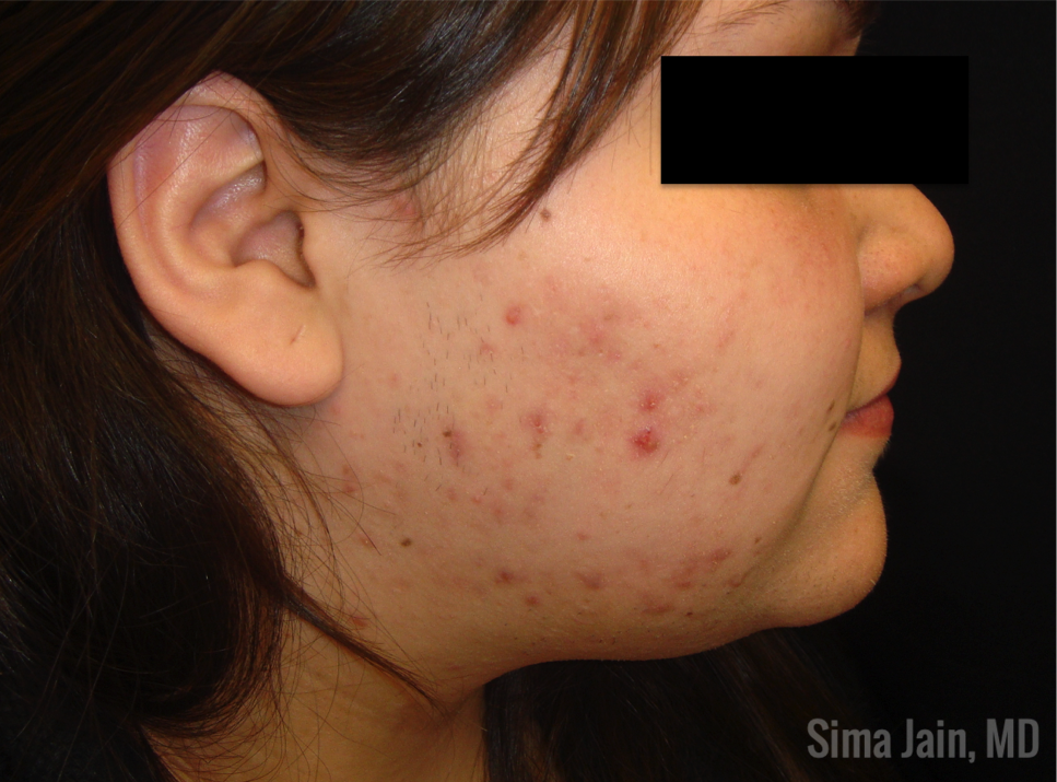 polycystic ovarian syndrome acne