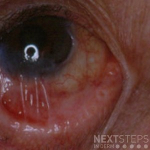ocular cicatricial pemphigoid