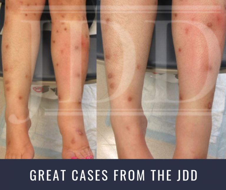 Dupilumab Treatment for Prurigo Nodularis and Pruritis Next Steps in