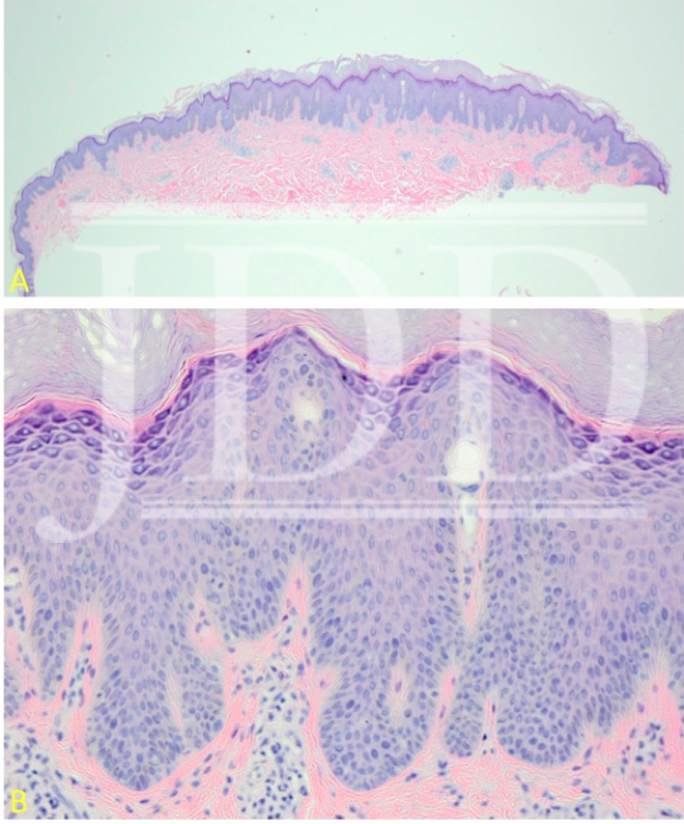 epidermal hyperplasia