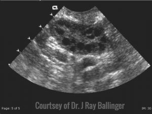 Ultrasound of Ovary