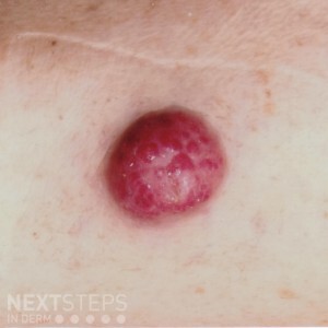 dermal mass