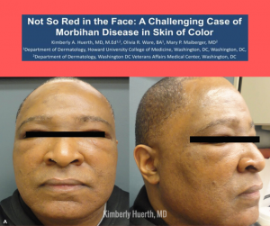Morbihan Disease