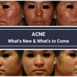 Acne in Skin of Color