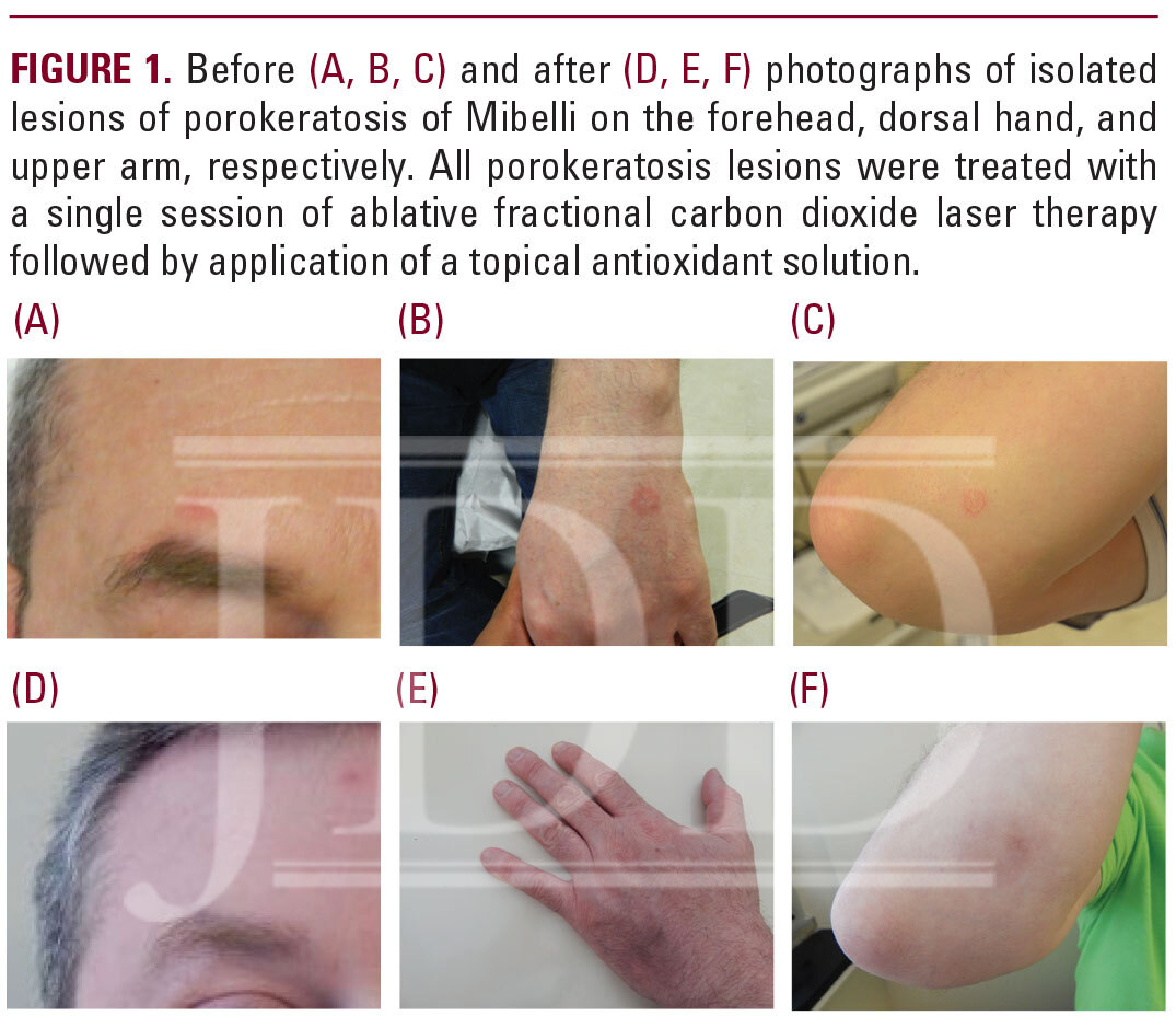 Porokeratosis of Mibelli