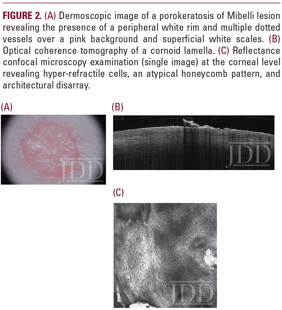 Dermoscopic image of a porokeratosis of Mibelli lesion