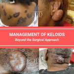 Medical and Surgical Management of Keloids