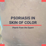 Psoriasis in Skin of Color