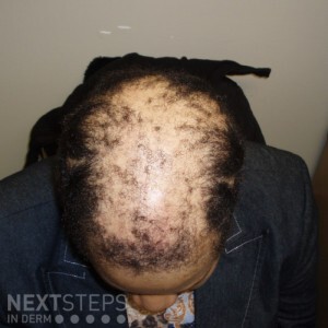 cicatricial alopecia