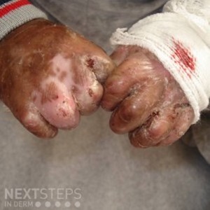 epidermolysis bullosa