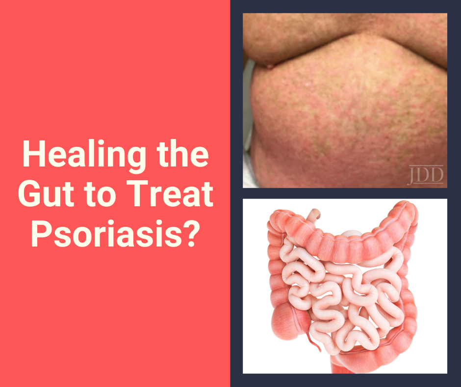 Healing the gut to treat psoriasis