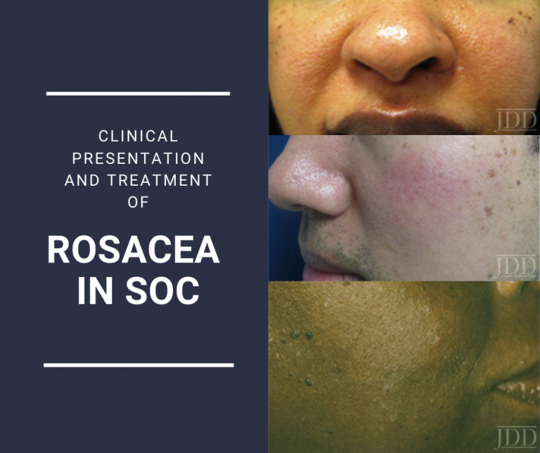 Rosacea Nuances In Clinical Presentation And Treatment Next Steps In Dermatology