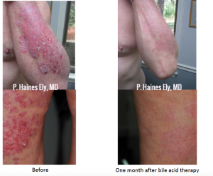 Before and after bile acid therapy
