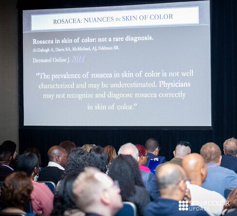 Rosacea in skin of color