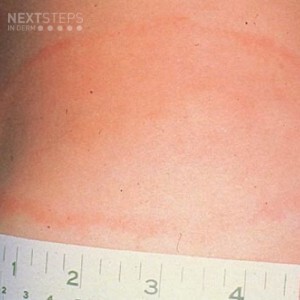 erythema migrans